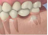 Cầu răng là gì