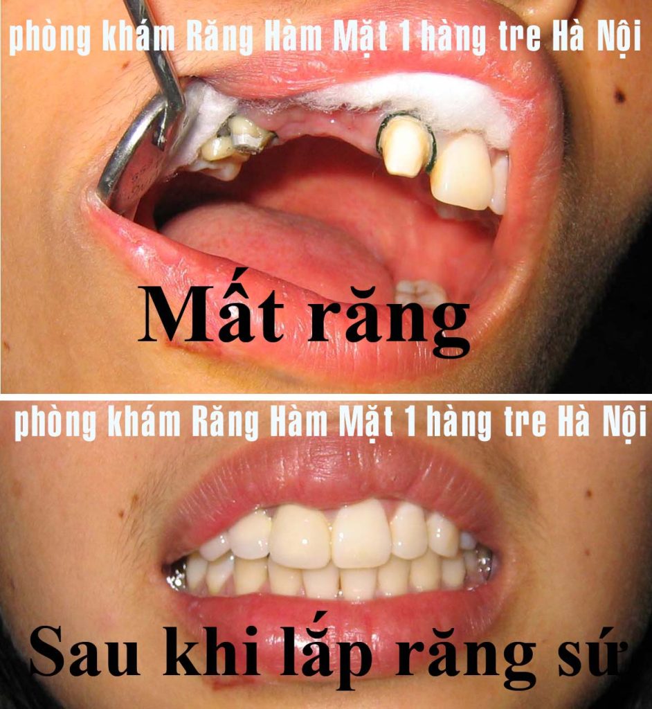 Răng hàm mặt